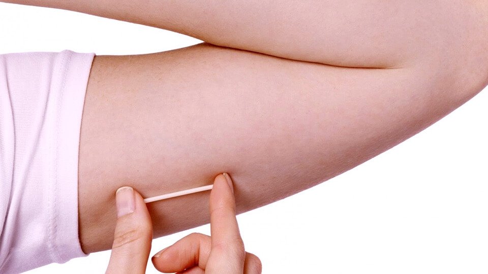 Método Contraceptivo: Implante Hormonal